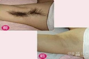 狐臭会不会传染